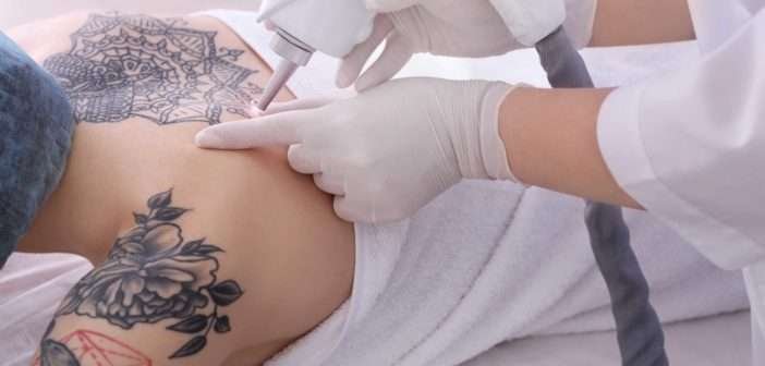 Retiro de tatuajes