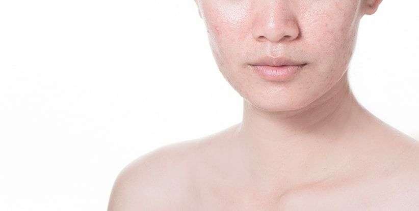 tratamiento acne en otoño