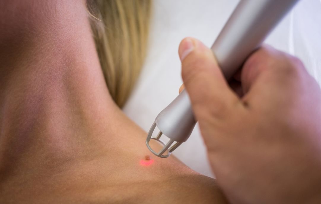 Procedimientos de Medicina Estética para Mejorar la Apariencia de las Cicatrices