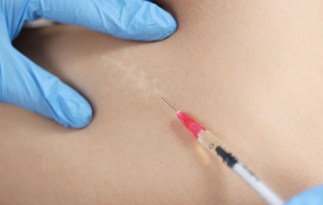Procedimientos de Medicina Estética para Mejorar la Apariencia de las Cicatrices