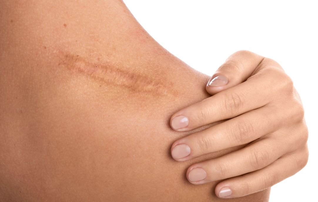 Procedimientos de Medicina Estética para Mejorar la Apariencia de las Cicatrices