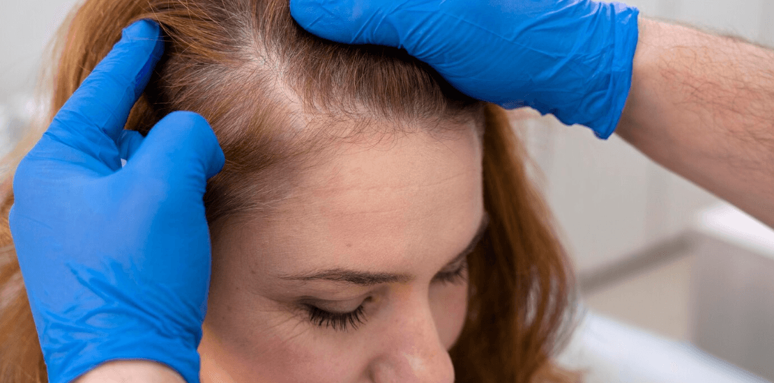 dermatologo caida de cabello