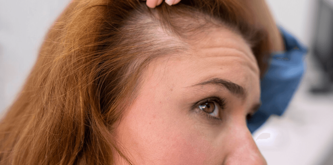 dermatologo caida de cabello