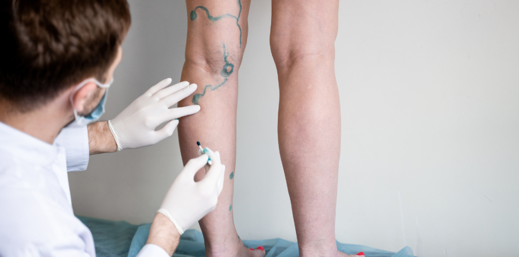 Tratamientos Minimamente Invasivos para Mejorar la Apariencia de las Venas Varicosas