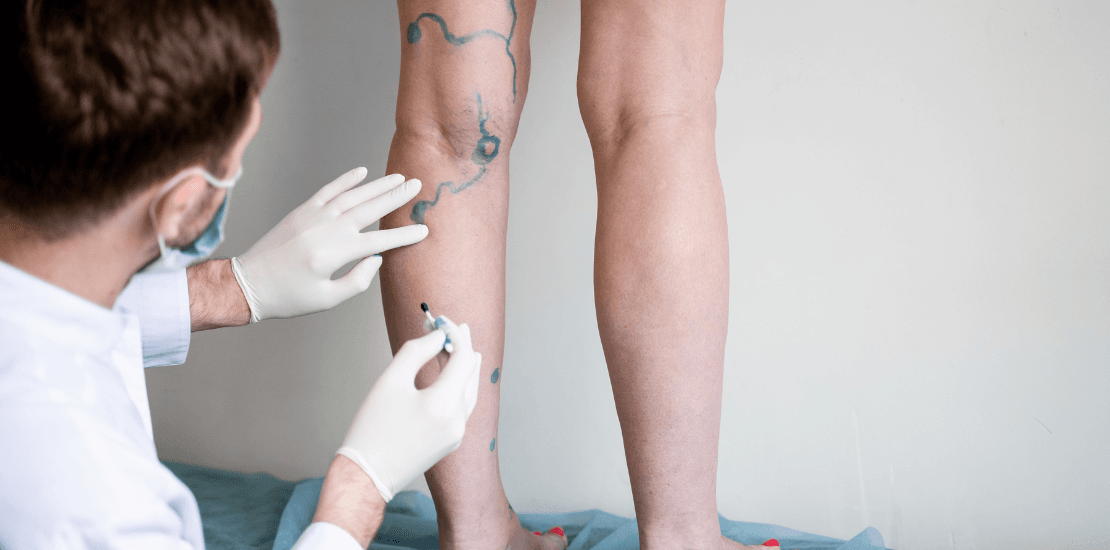 Tratamientos Minimamente Invasivos para Mejorar la Apariencia de las Venas Varicosas