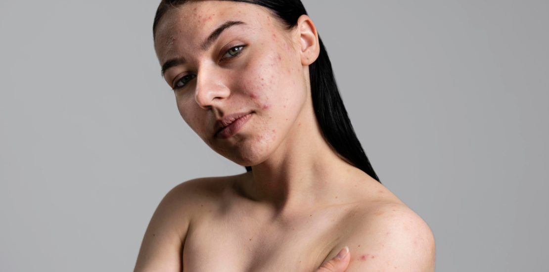 Tratamientos Avanzados para Combatir las Manchas y la Hiperpigmentación