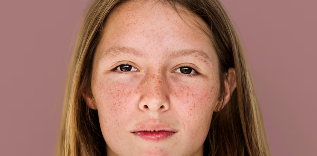 ¿Melasma o léntigo solar