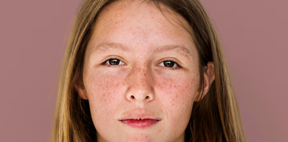 ¿Melasma o léntigo solar