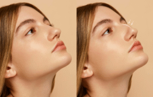 Rinomodelación ácido hialurónico CDMX: perfila tu nariz sin cirugía