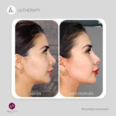 Ultherapy levantamiento facial sin cirugia antes y despues.